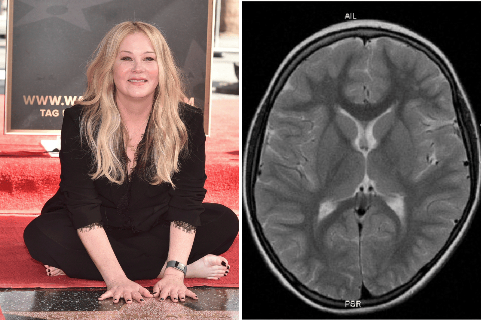Christina Applegate Discusses Misdiagnosis of Multiple Sclerosis