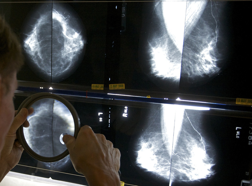 Breast Cancer Risk Assessment and Prevention